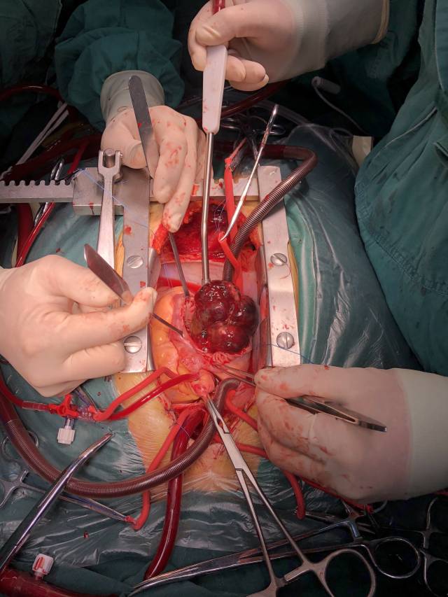 心脏也会长肿瘤,1例巨大右心房黏液瘤