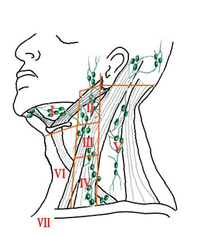 颈部淋巴结分区示意图图片
