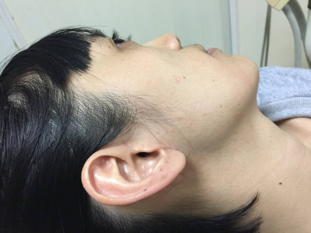 腮腺混合瘤手术疤痕图图片