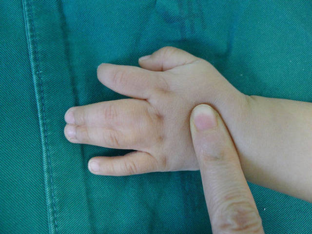 双翼皮瓣成形指蹼-——并指不植皮或减少植皮的新方法