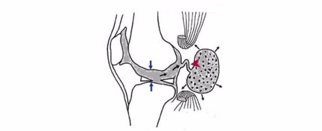 膝盖膎窝囊肿位置图图片