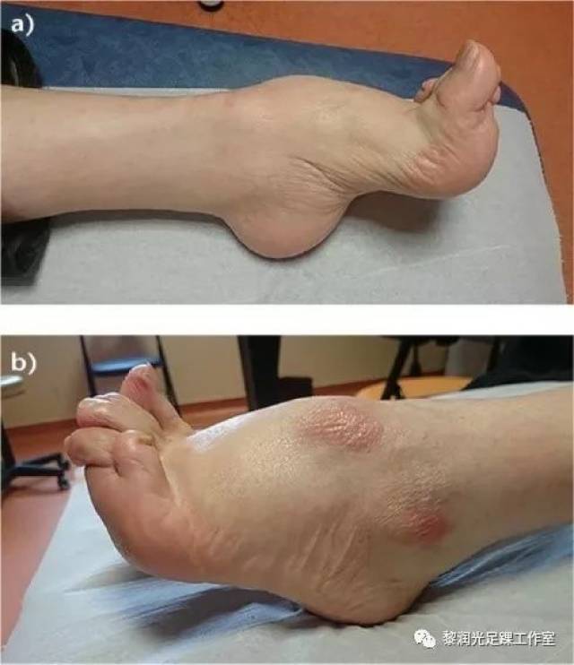 中风引起的脚部畸形如何治疗?