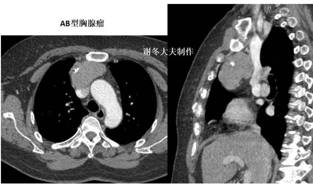 胸腺瘤/前縱隔佔位/前縱隔結節是癌症嗎