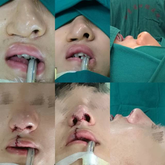 唇裂二期的整复手术