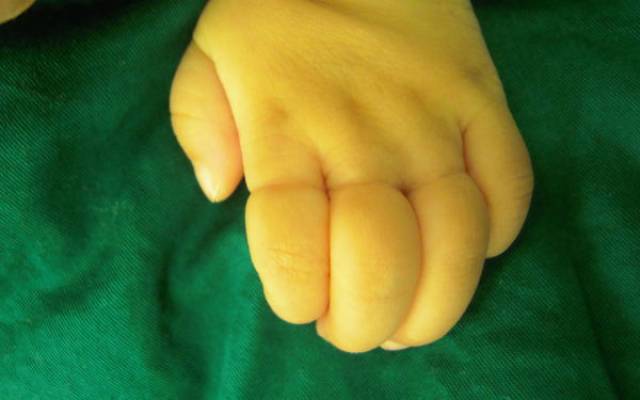手指束带综合症图片图片