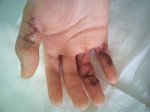残端手术后的手指图图片
