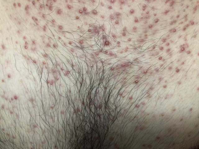 得了男性外生殖器毛囊炎别着急,看了这文章就清楚了