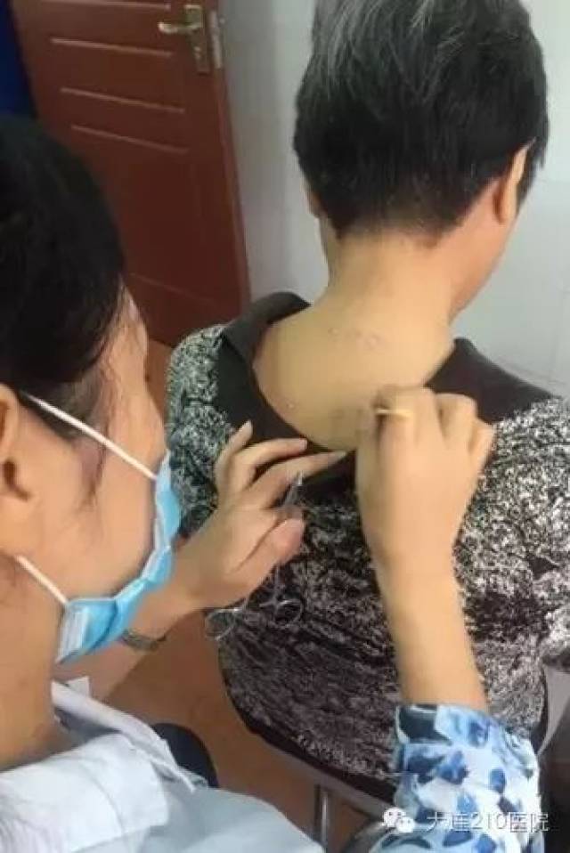 【中医知识宣教】皮内针疗法