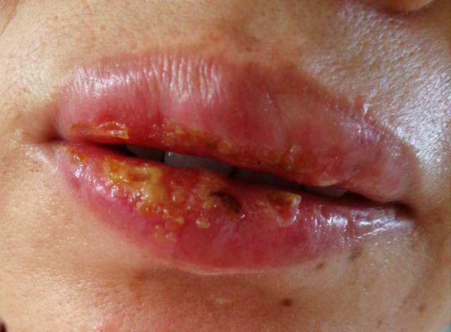 唇炎几种症状图片图片