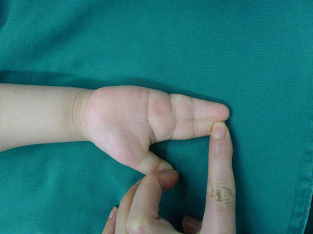 双翼皮瓣成形指蹼-——并指不植皮或减少植皮的新方法