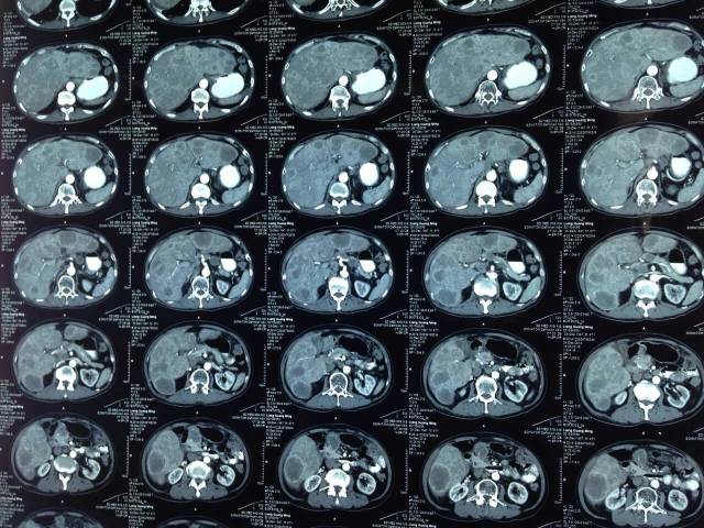 胃癌晚期肝轉移化療前後ct--典型病例梁xx