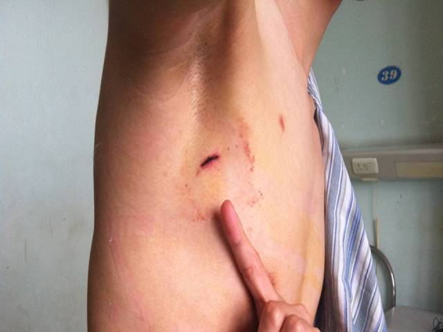 胸腺瘤/前纵隔占位/前纵隔结节是癌症吗