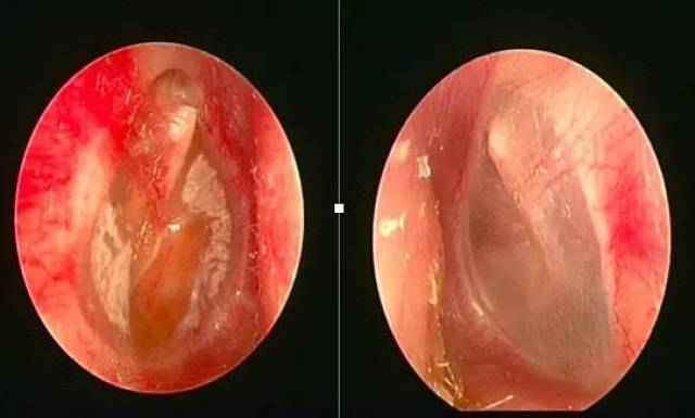 咽鼓管异常开放症图片