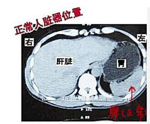 如仰卧位或侧卧位能摸到脾脏边缘应认为脾脏肿大