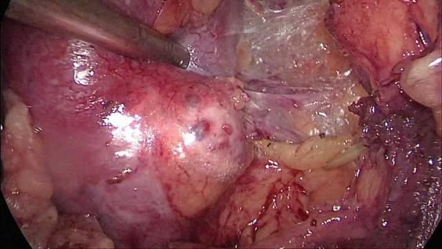 肾肿瘤保留肾单位手术(nss)--肾癌的微创治疗