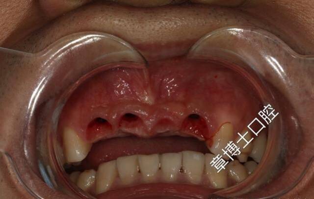 临时牙戴入