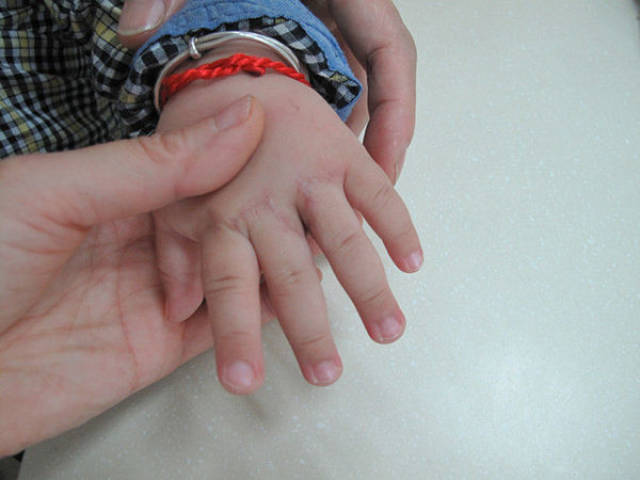 双翼皮瓣成形指蹼-——并指不植皮或减少植皮的新方法