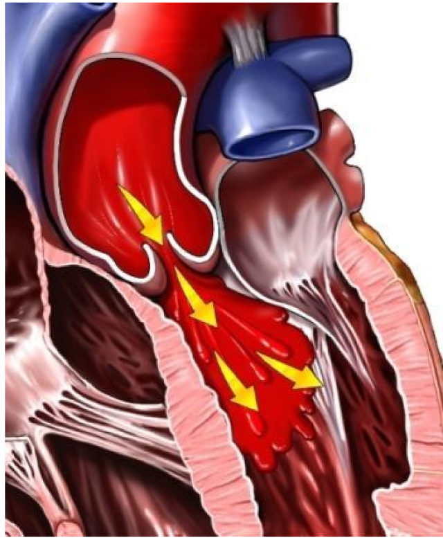 肺动脉瓣反流图片