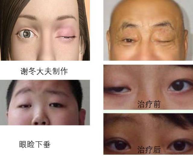 典型的眼睑下垂