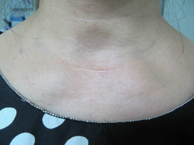甲状腺癌手术刀疤图图片
