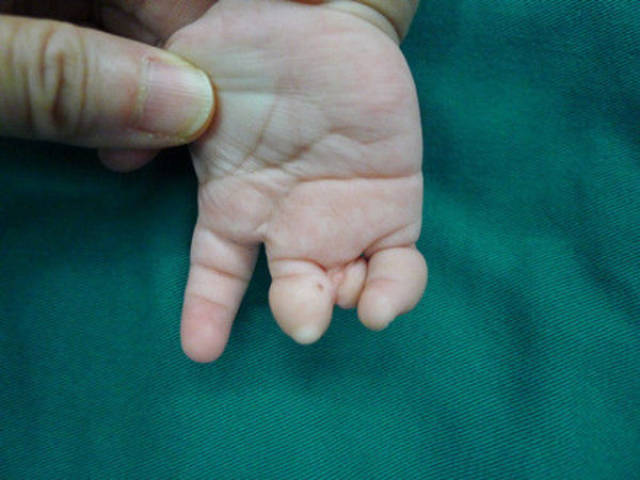 手指束带综合症图片图片