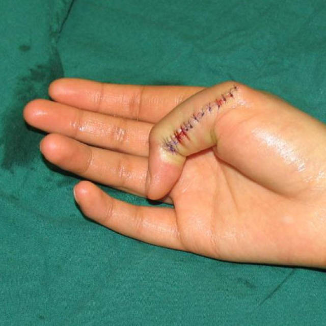 大人六个手指头可以切除六指手术前后的图片6个指头小孩