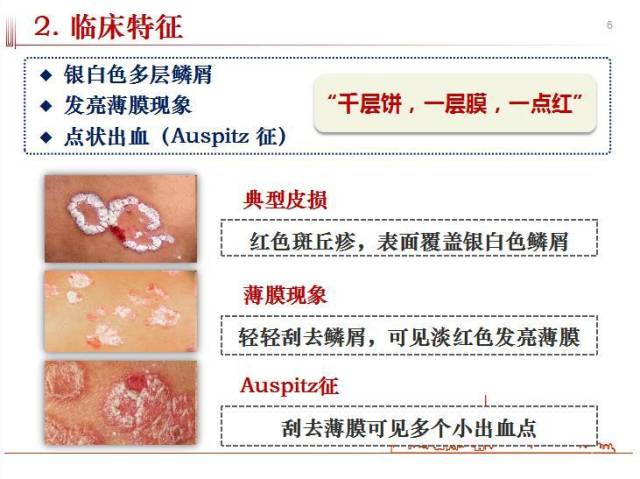 银屑病常见问答