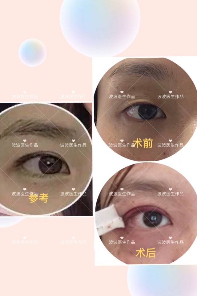 想做这种眼睛,她本身身材高挑气质不错,但是眼睛(图2)有近视,突眼,不