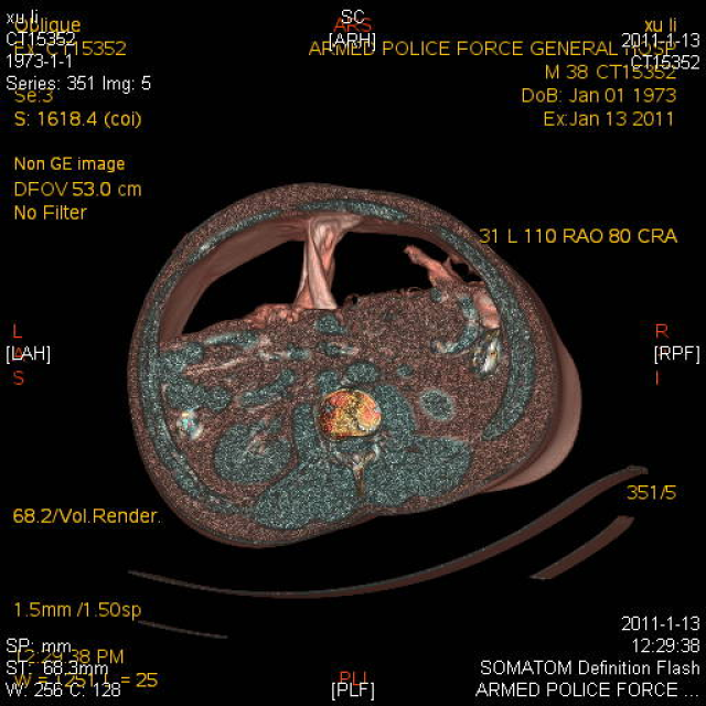 气腹ct影像诊断术后肠粘连