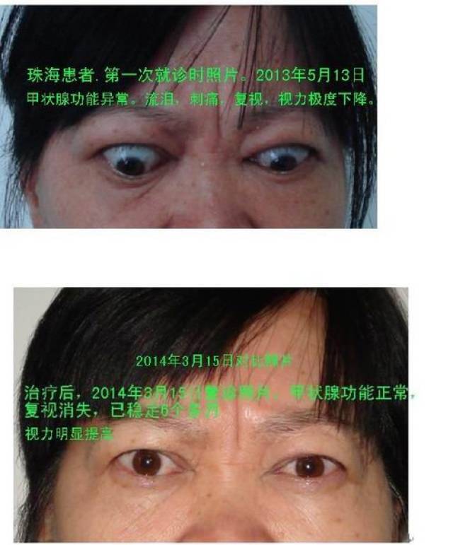 重症甲亢突眼怎么治疗?突眼典型病例治疗前后照片对照(图)