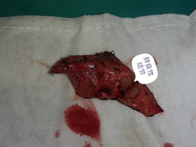 右上肺结节,胸腔镜右上肺楔形切除,术中冰冻:良性