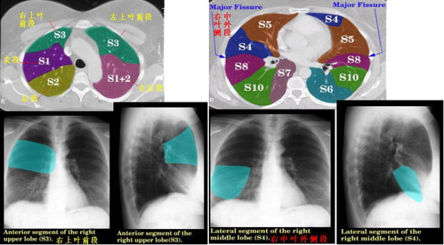 看完这些图,你就能看懂肺部ct! (转载)