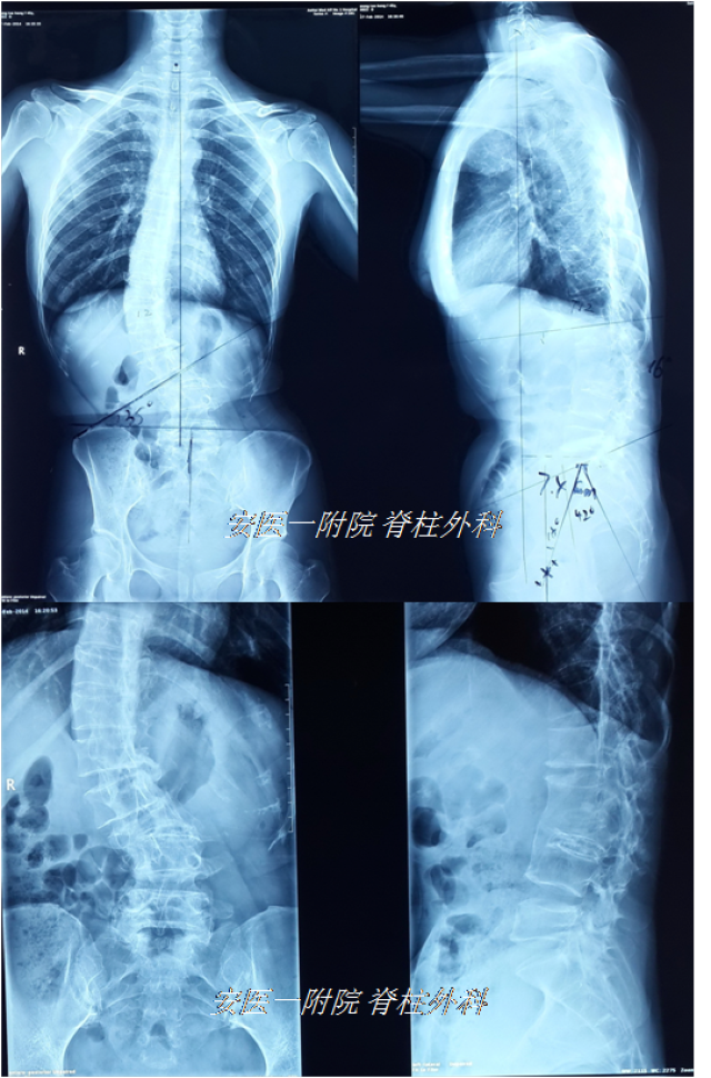 成人脊柱侧后凸畸形1(脊柱骨折畸形愈合)