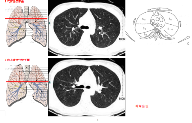 手把手教你读懂肺部CT图片
