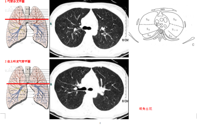 新手看肺部ct片图解图片