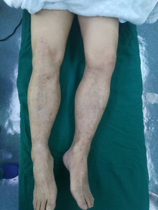 严重膝内翻双膝人工关节置换