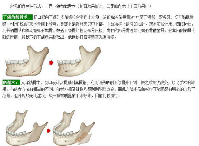 akin截骨术示意图图片