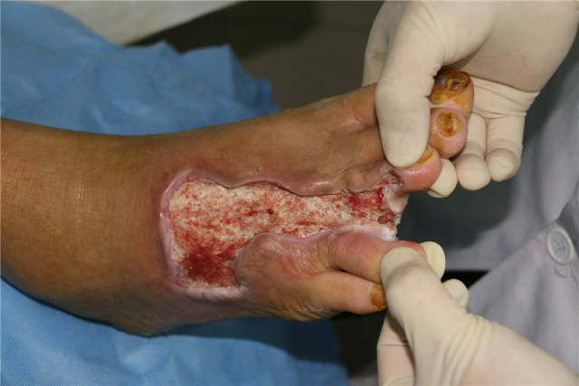 糖尿病足溃疡