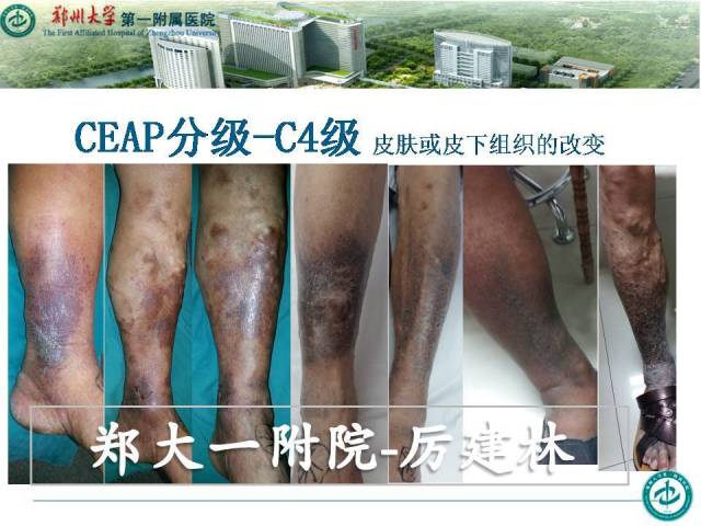 下肢静脉曲张CEAP分级_手机搜狐网