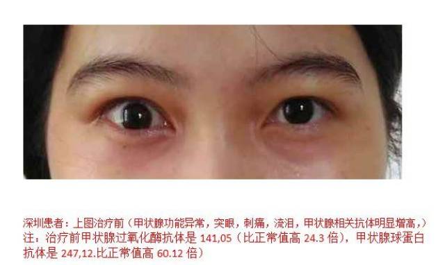 近期甲亢突眼患者治療對照照片