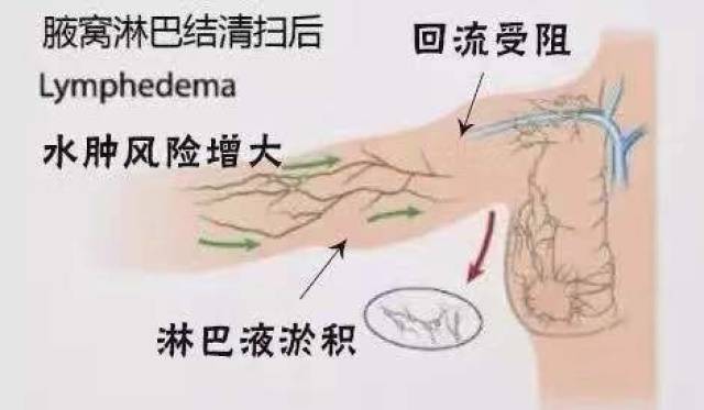 【一文讀懂】乳腺癌術後上肢淋巴水腫的預防與治療