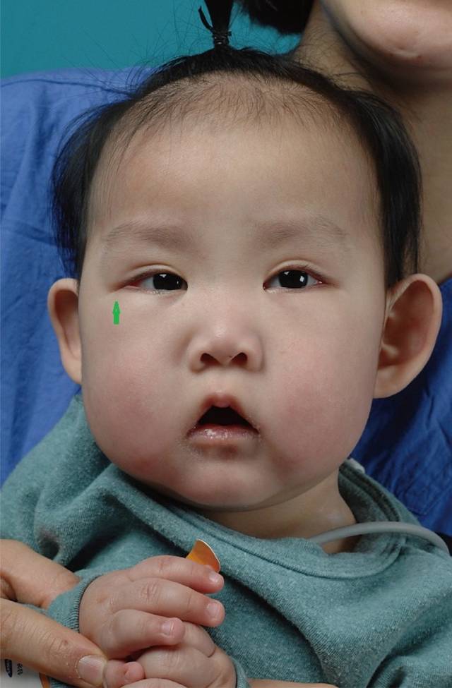 kabuki 综合征(歌舞伎脸谱综合征)