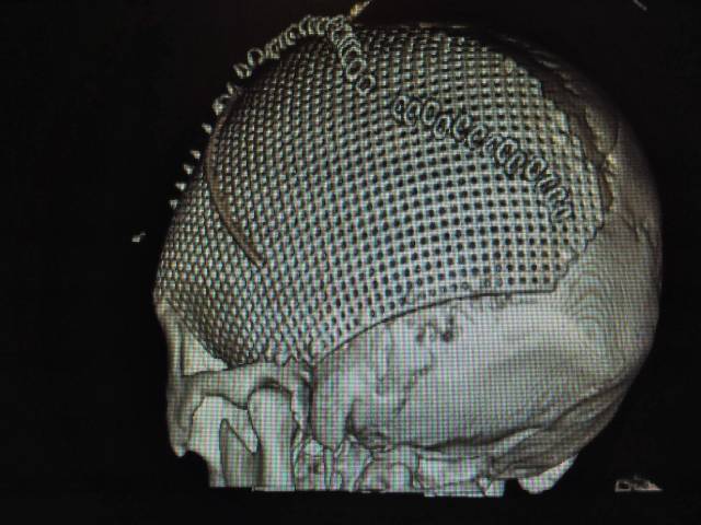 巨大顱骨缺損修補手術一例