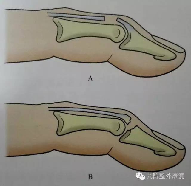 锤状指的治疗与康复