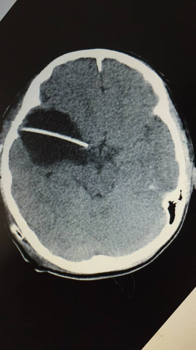 儿童脑内有蛛网膜囊肿怎么办?