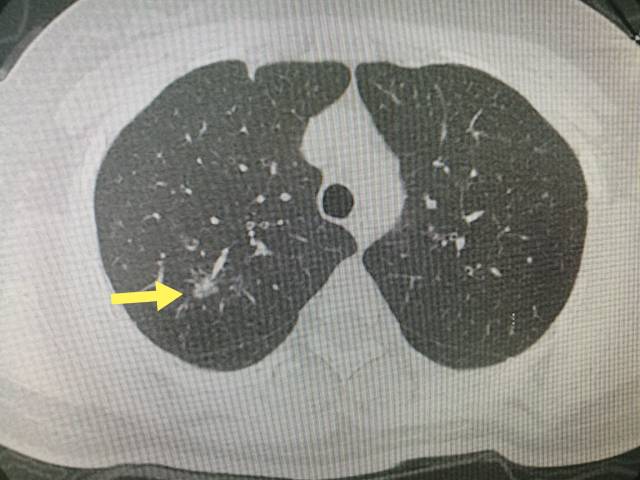 肺磨玻璃结节之十问十答