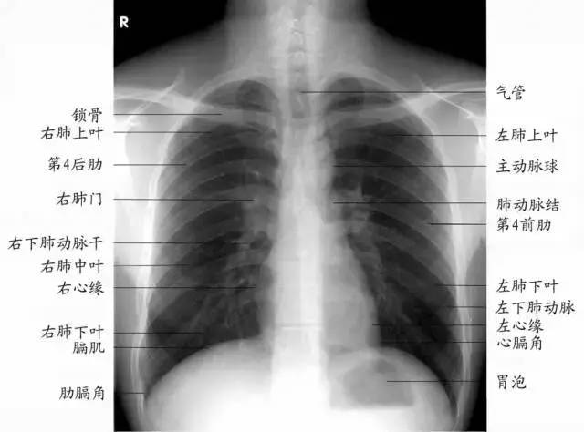 肺门x线图片图片