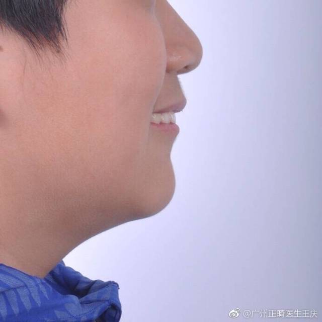 功能矫治器治疗下颌后缩