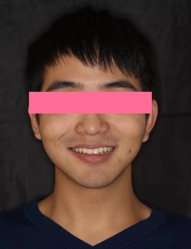 矫正后的上牙排列整齐,牙中线对齐之后,笑容明显更加阳光大气了.