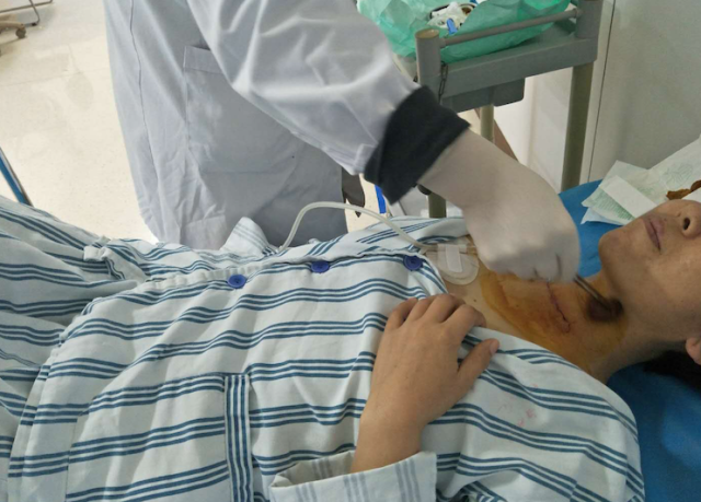 主治医师在给患者拆线